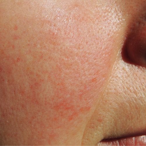 How-can-i-heal-my-rosacea-skin