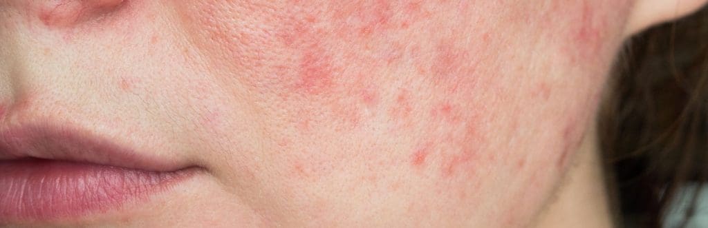 How can I heal my rosacea skin