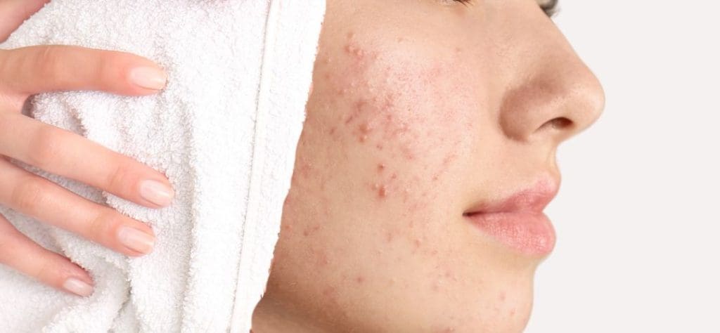 Acne